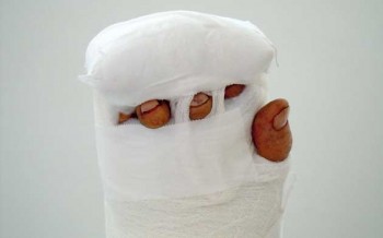 La mano destra fasciata dopo l’intervento