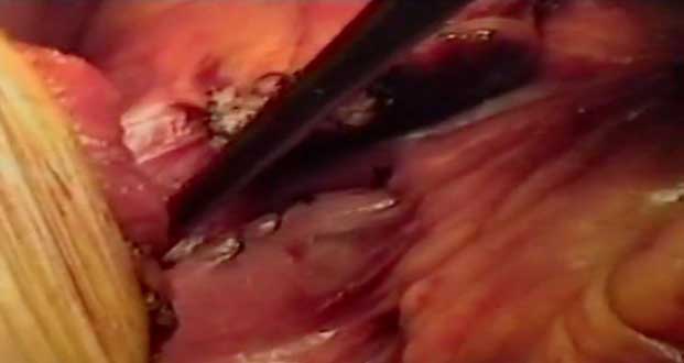 DUODENOCEFALOPANCREASECTOMIA PROF. CARLO DI MARTINO