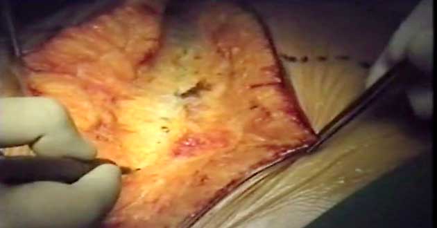 TUMORE GIGANTE SURRENE DS PROF. CARLO DI MARTINO