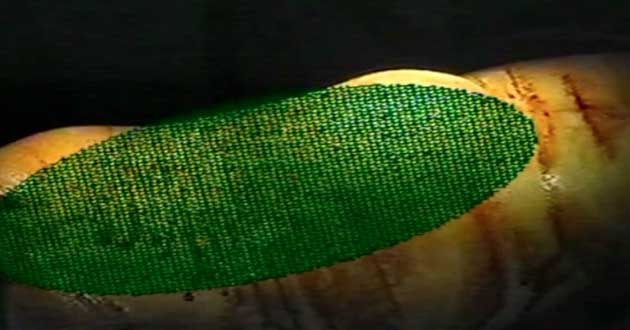 Di Martino Ernia Permagna