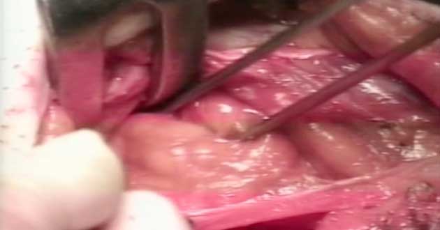 Ernioplastica di Celdran Prof. Di Martino